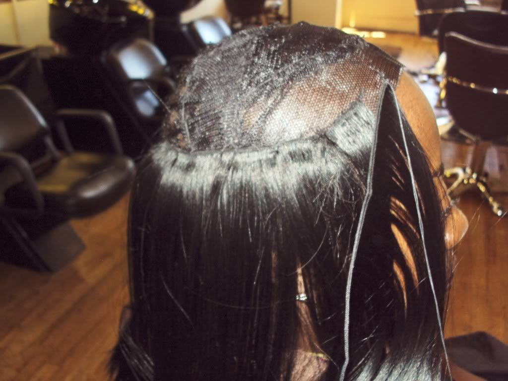 hair photo:scalp fungus hair loss 